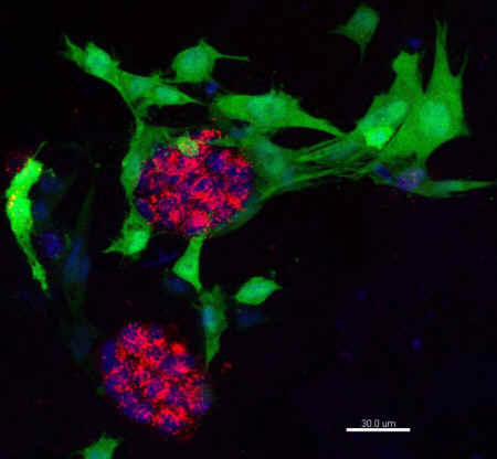 breast cancer cells